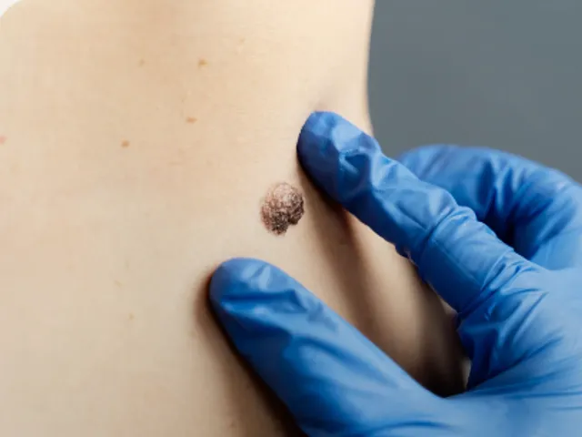 Wart / Mole Removal